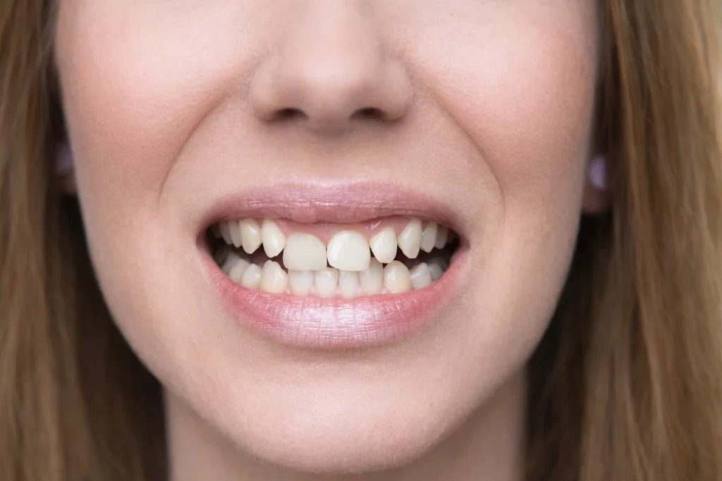 How to Fix Crowded Teeth. The Causes, Treatments, and Where to Go