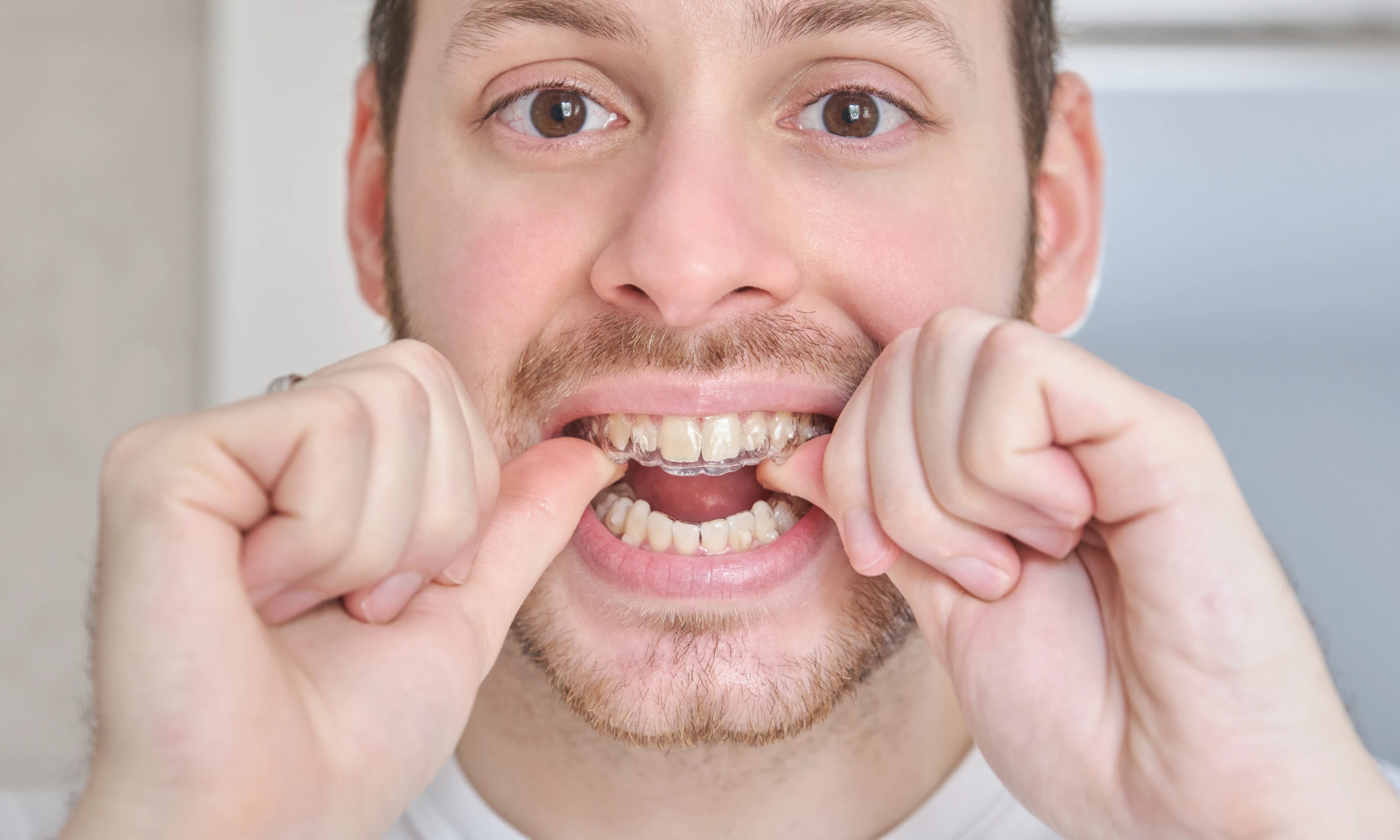 Invisalign in Lincoln: What to Expect at Treeline Dental Suite