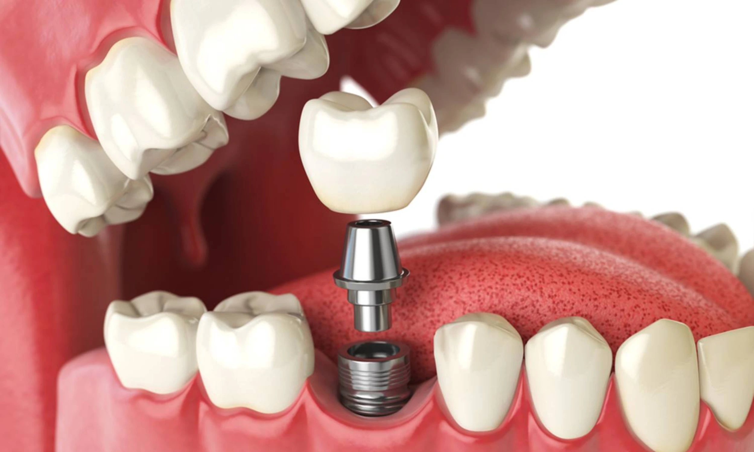 Dental Implants in Lincoln: Treeline Dental Suite's Complete Guide
